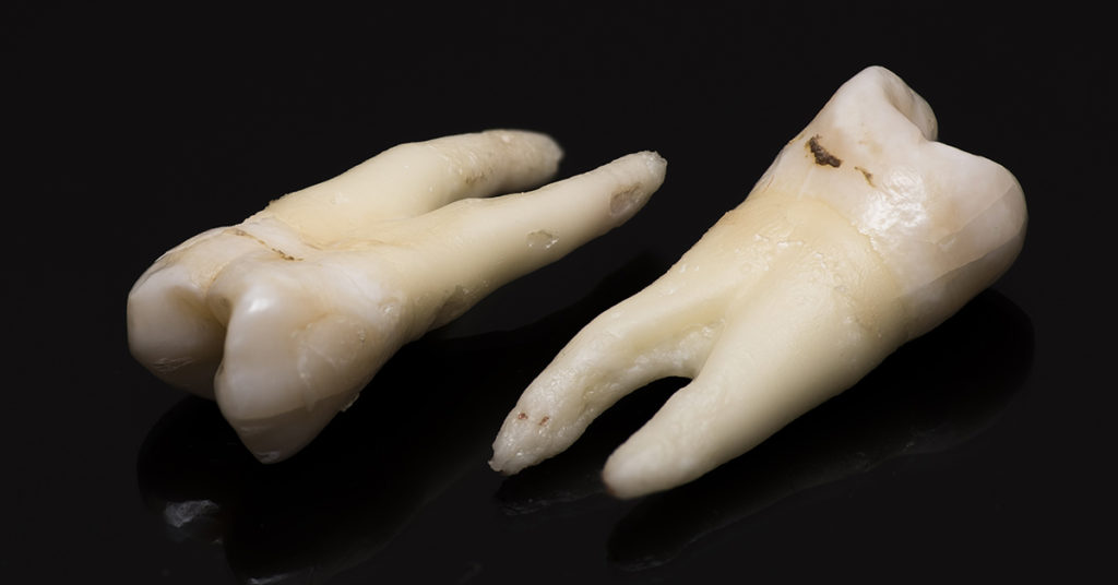 People Are Getting Jewelry Made From Loved One’s Teeth and I’m So Horrified, I’ll Never Sleep Again - Featured image