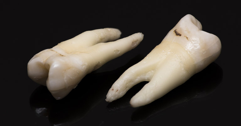 People Are Getting Jewelry Made From Loved One’s Teeth and I’m So Horrified, I’ll Never Sleep Again - Featured image