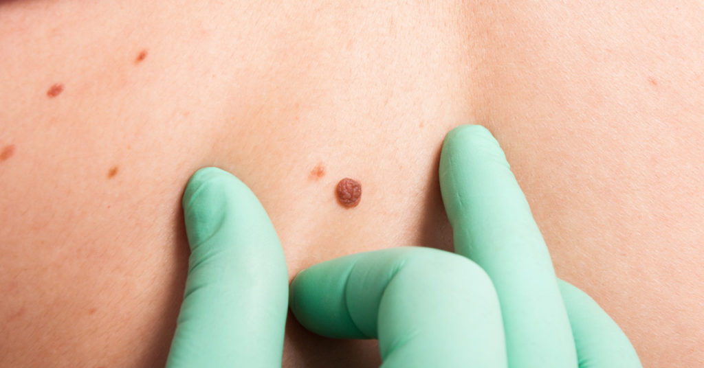 Dermatologists Explain 12 Skin Cancer Symptoms That Most People Miss - Featured image