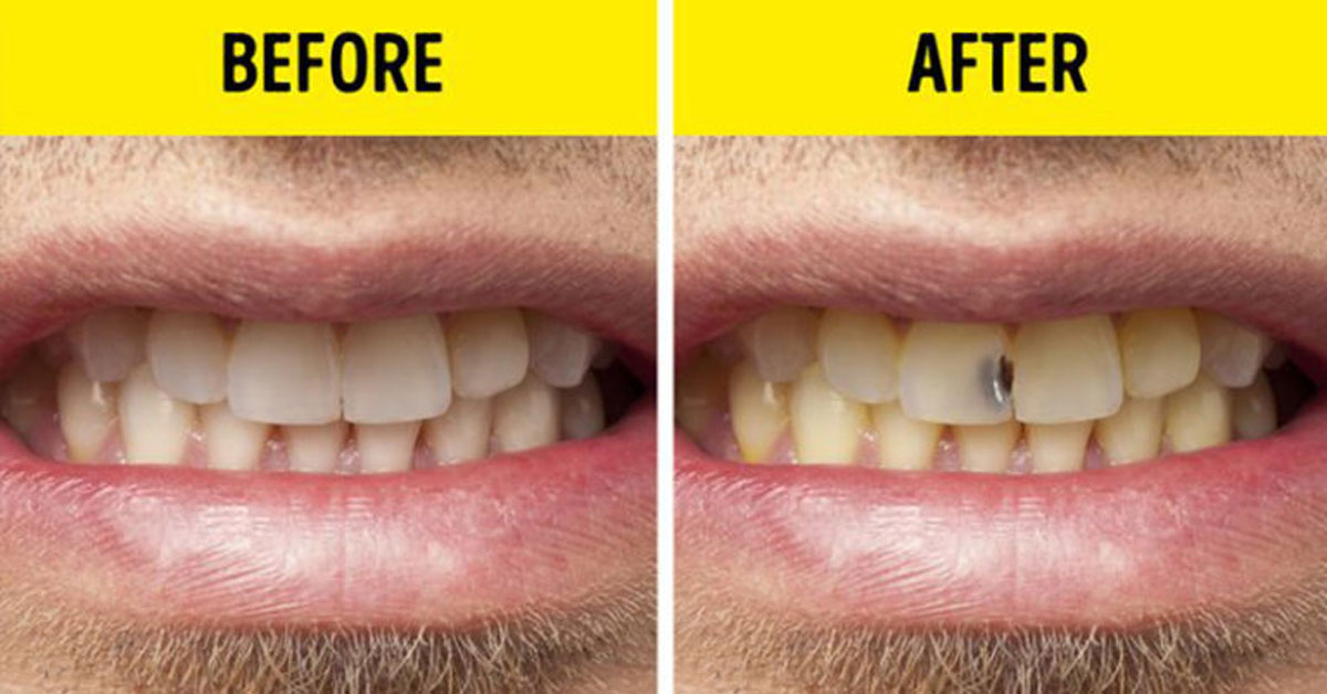 teeth before and after