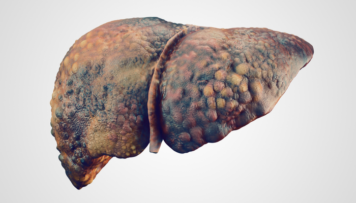 a representation of an unhealthy liver
