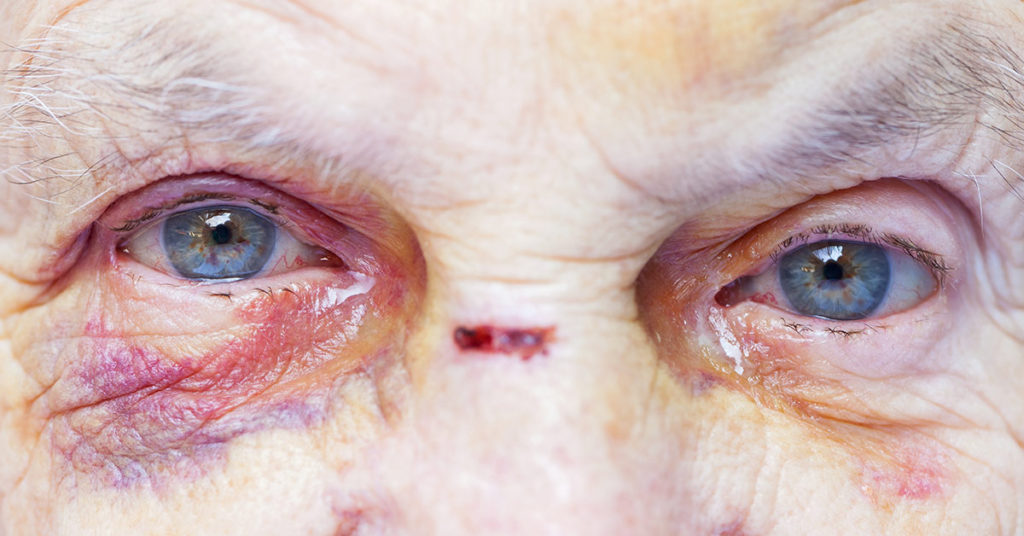 Nursing Home Workers Were Once Arrested for Running Elderly Fight Club Between Dementia Patients - Featured image