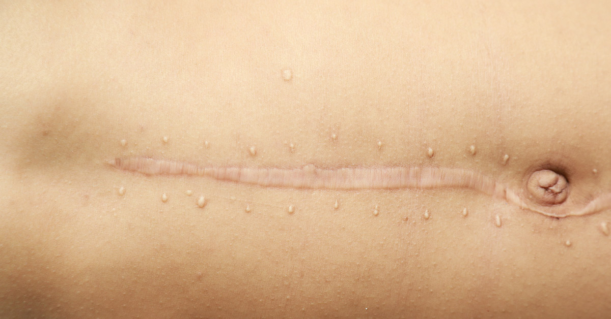 close up of abdominal scar
