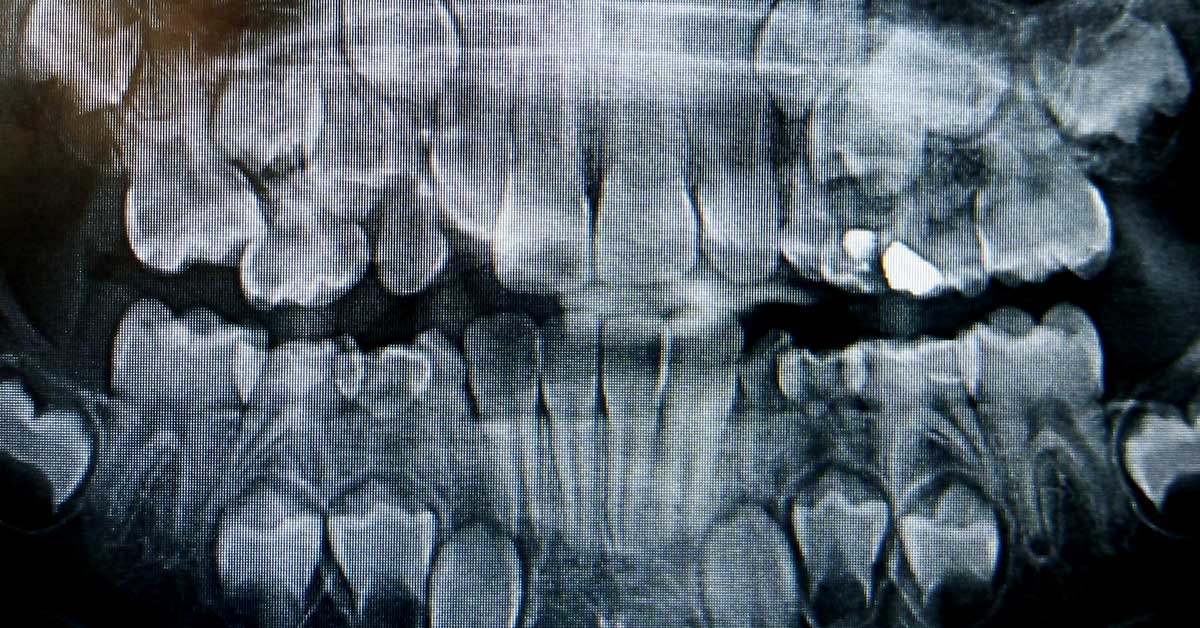 dental X-ray showing several teeth