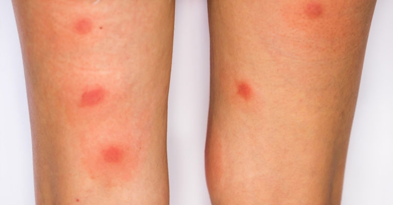 Bug Bite Identification: 10 Common Bug Bites With Pictures - Featured image