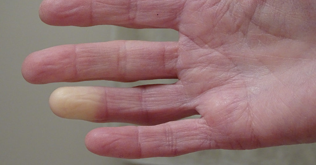 Rare disorder can turn fingers and toes white or blue when it’s cold - Featured image