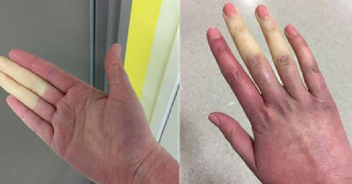 Rare disorder can turn fingers and toes white or blue when it's cold