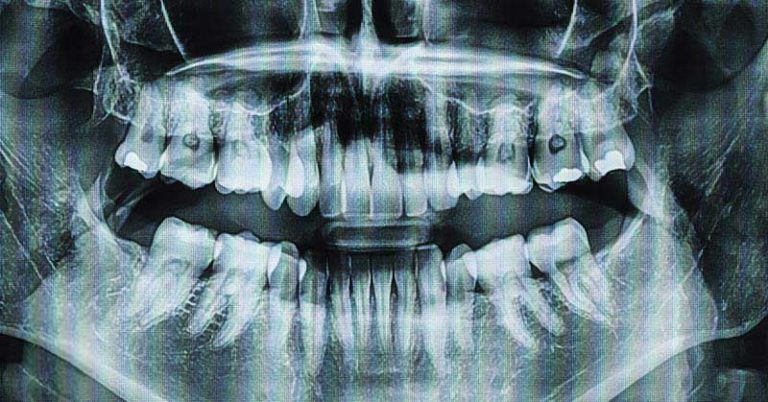 Scientist May Have Discovered a Drug that Fixes Cavities and Regrows Teeth - Featured image