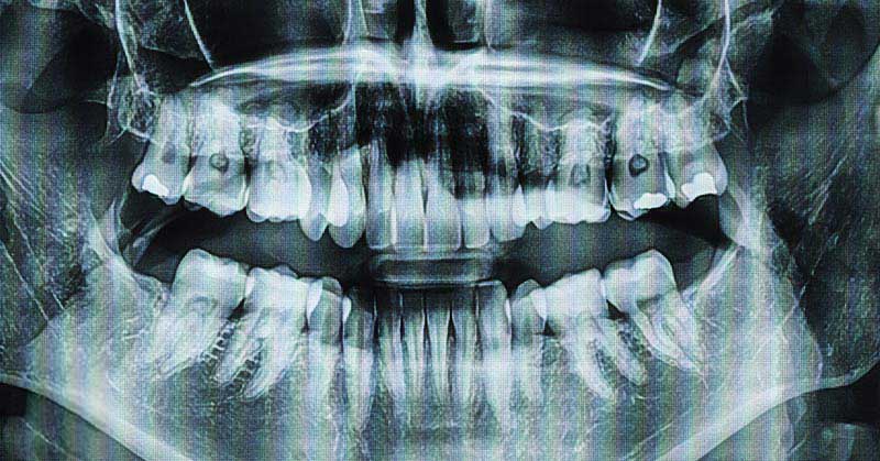 xray of mouth