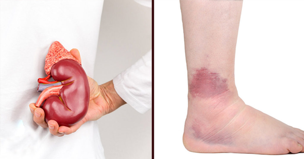 If Your Kidneys Are in Danger, Your Body Will Give You These 21 Signs - Featured image