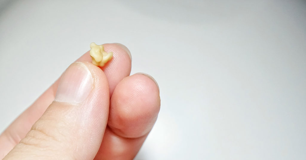 4 Things That Cause Tonsil Stones (And How to Prevent Them) - Featured image