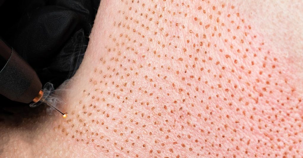 Woman left traumatized with dozens of scars after botched beauty treatment - Featured image