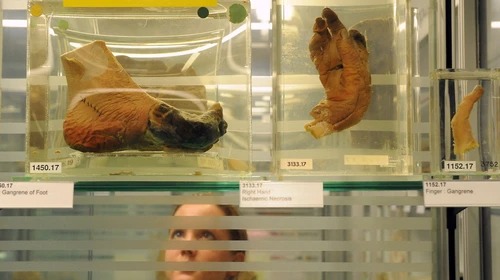 Human remains at a museum in Australia 