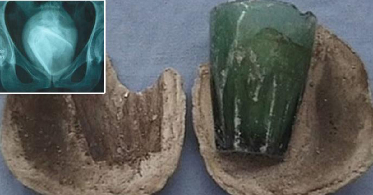 Woman's 'UTI' turns out to be a glass tumbler lodged in her bladder for