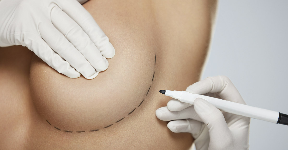 breasts being marked with marker for surgery prep