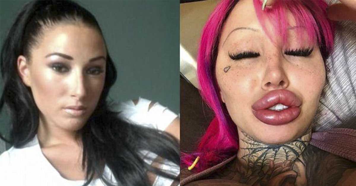 After Lip Lifting A Woman Who Almost Died From Her Surgery Addiction