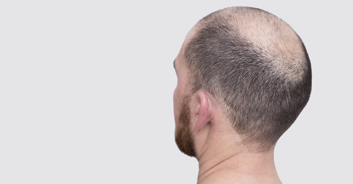back of balding man's head