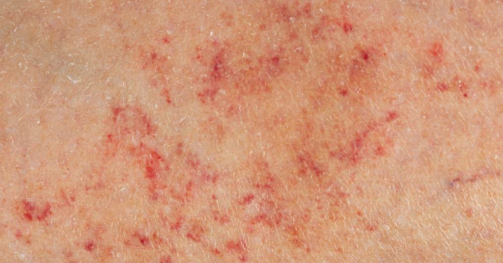 Woman shocked to discover tiny dots on skin were a sign of something worse. - Featured image