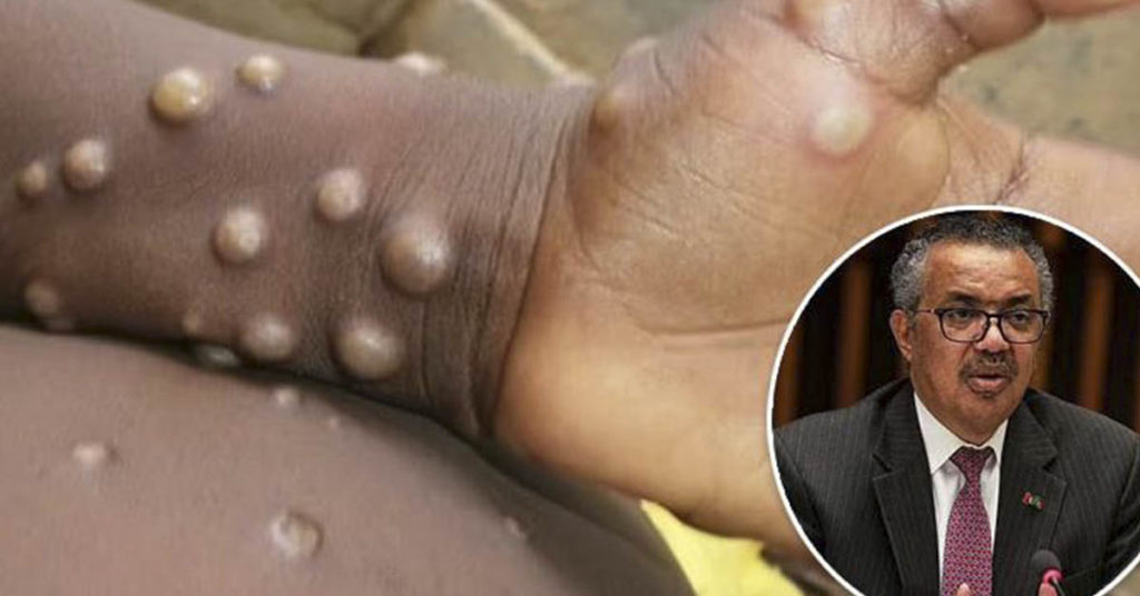 WHO to rename monkeypox 'because the name is RACIST'