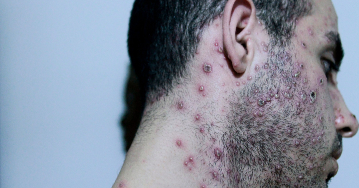 man displaying symptoms of monkeypox