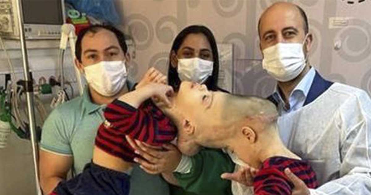 3YearOld Conjoined Twins With Fused Brains Separated in Historic