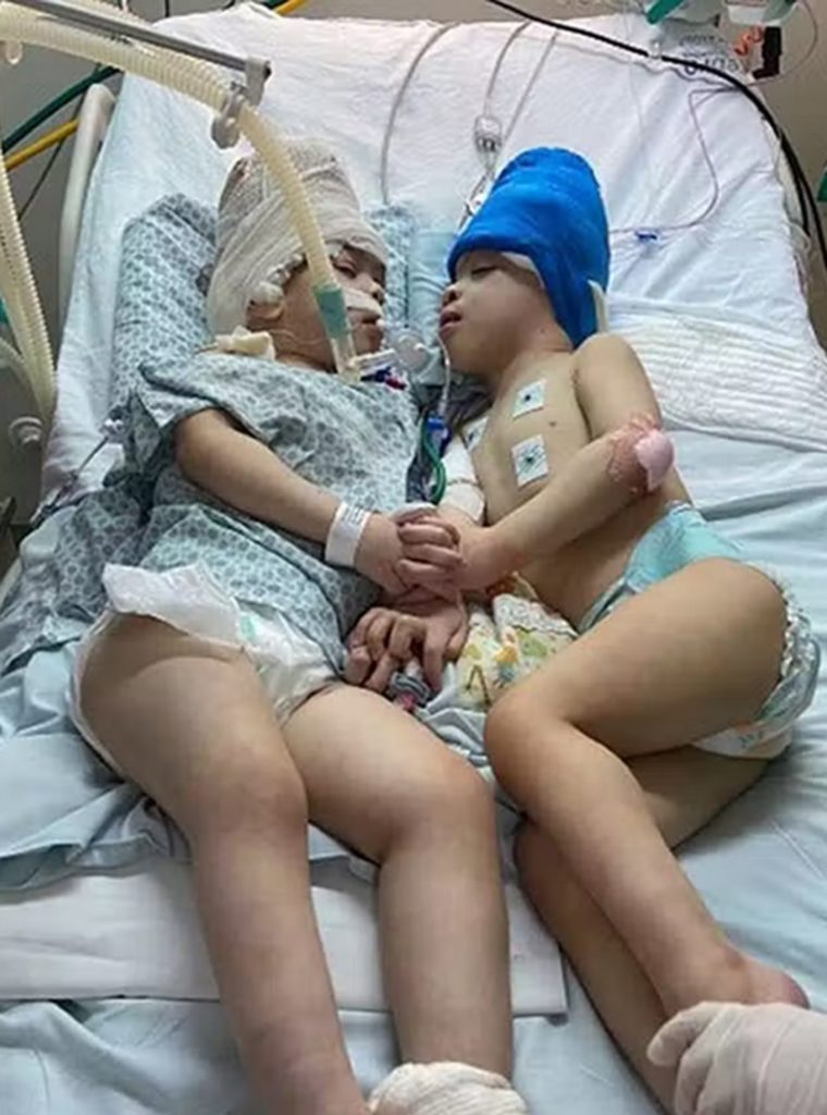 previously conjoined twins after surgery 