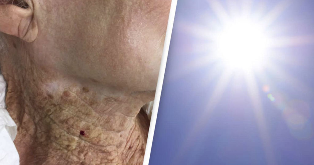 Striking picture shows consequences of 92-year-old woman using sun scr...