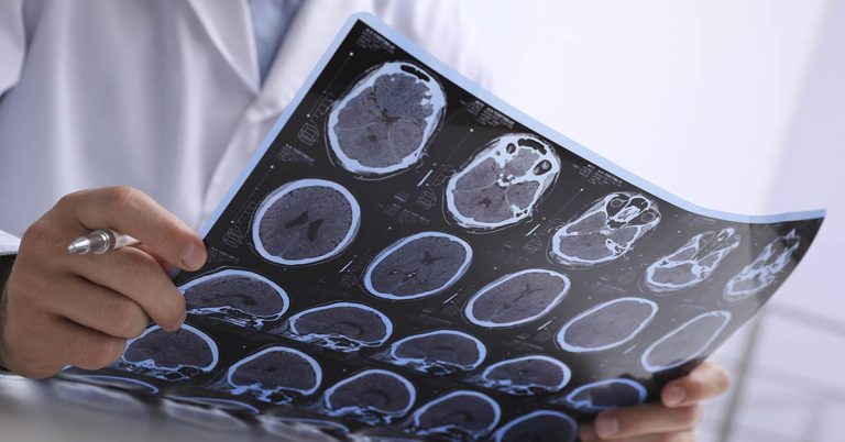 Is a Virus We All Have Causing Multiple Sclerosis? - Featured image