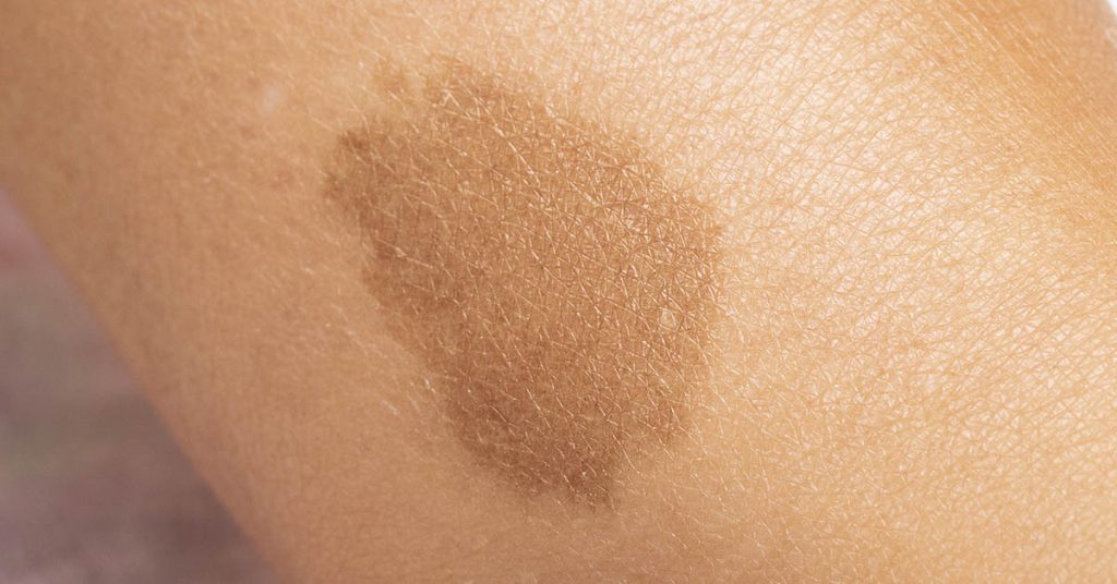 A stranger noticed Jackie Briggs’ birthmark. It saved her life - Featured image
