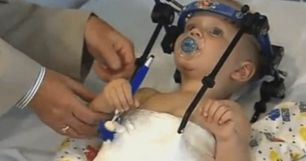 infant with halo brace after Internal Decapitation