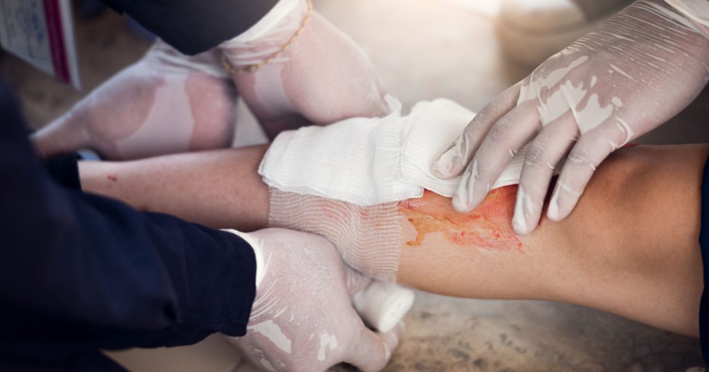 Mother nearly dies after 13-year-old bite turns into sepsis - Featured image