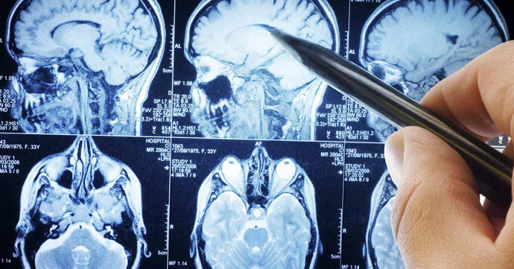 11-Year-Old Girl’s Brain Tumor Disappears in Medical Mystery - Featured image