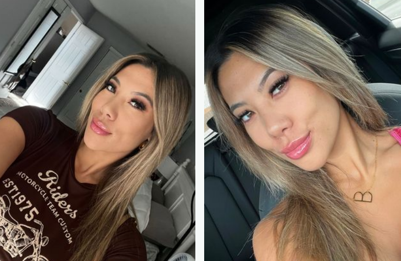 The Lip Filler Left The Young Woman With Disfigured Lips