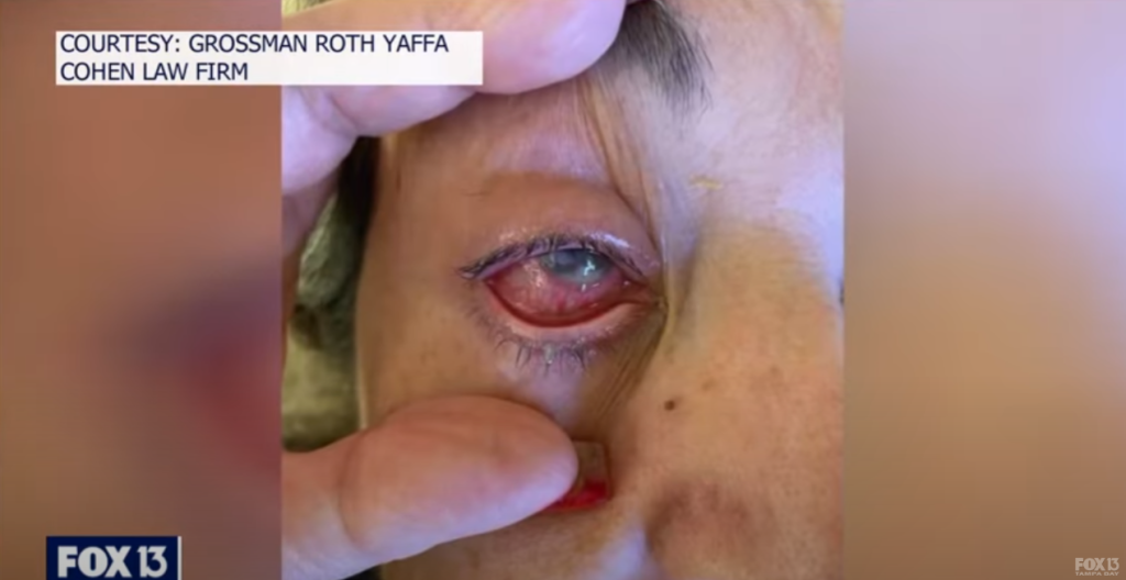 Clara Oliva's damaged eye
