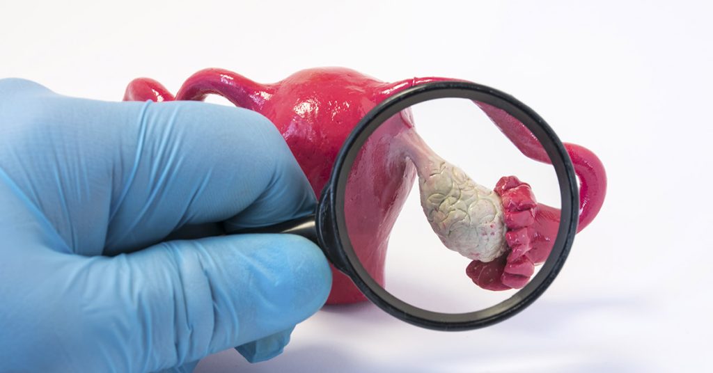 Woman has 100lb ovarian cyst removed