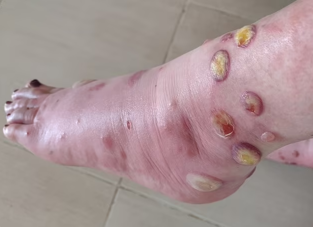 Massive mosquito bites covered her feet