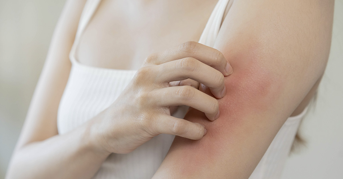 woman scratching red rash on arm