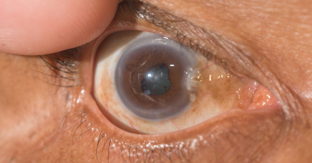 close up of persistent pupillary membrane during ophthalmic examination.
