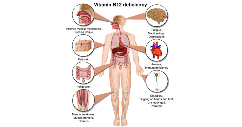 Vitamin B12 deficiency infographic, 3d medical vector illustration on white background
