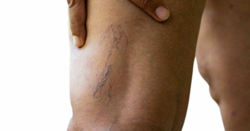 Varicose veins on young women legs
