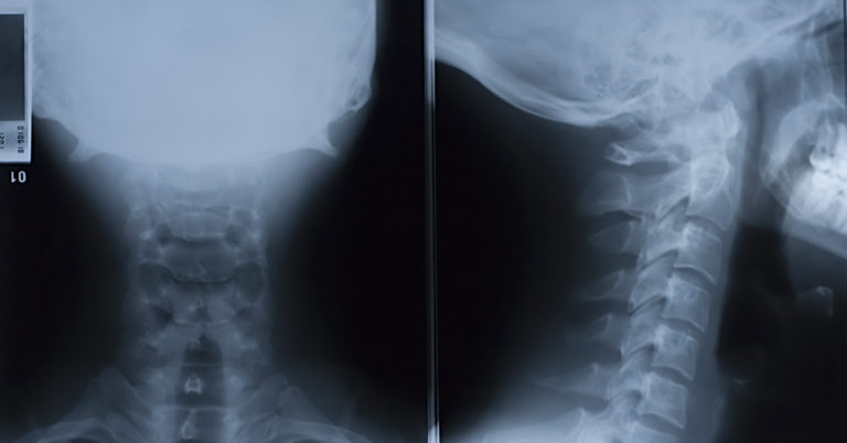 Doctor Gives Warning Over Holding in a Sneeze After Man Damages Throat - Featured image