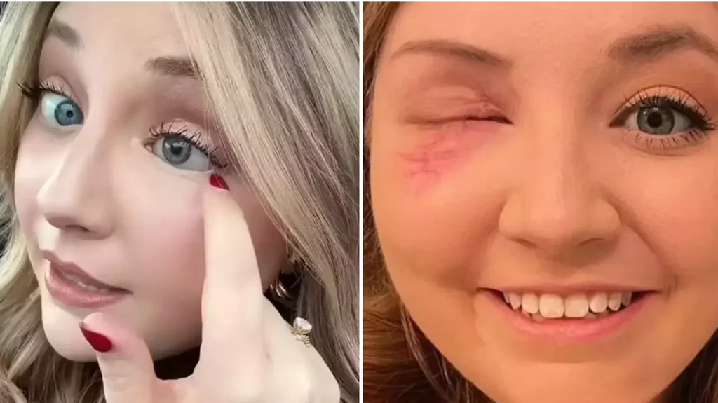Woman showing eye injury
