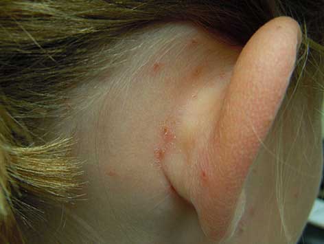 lice bites 