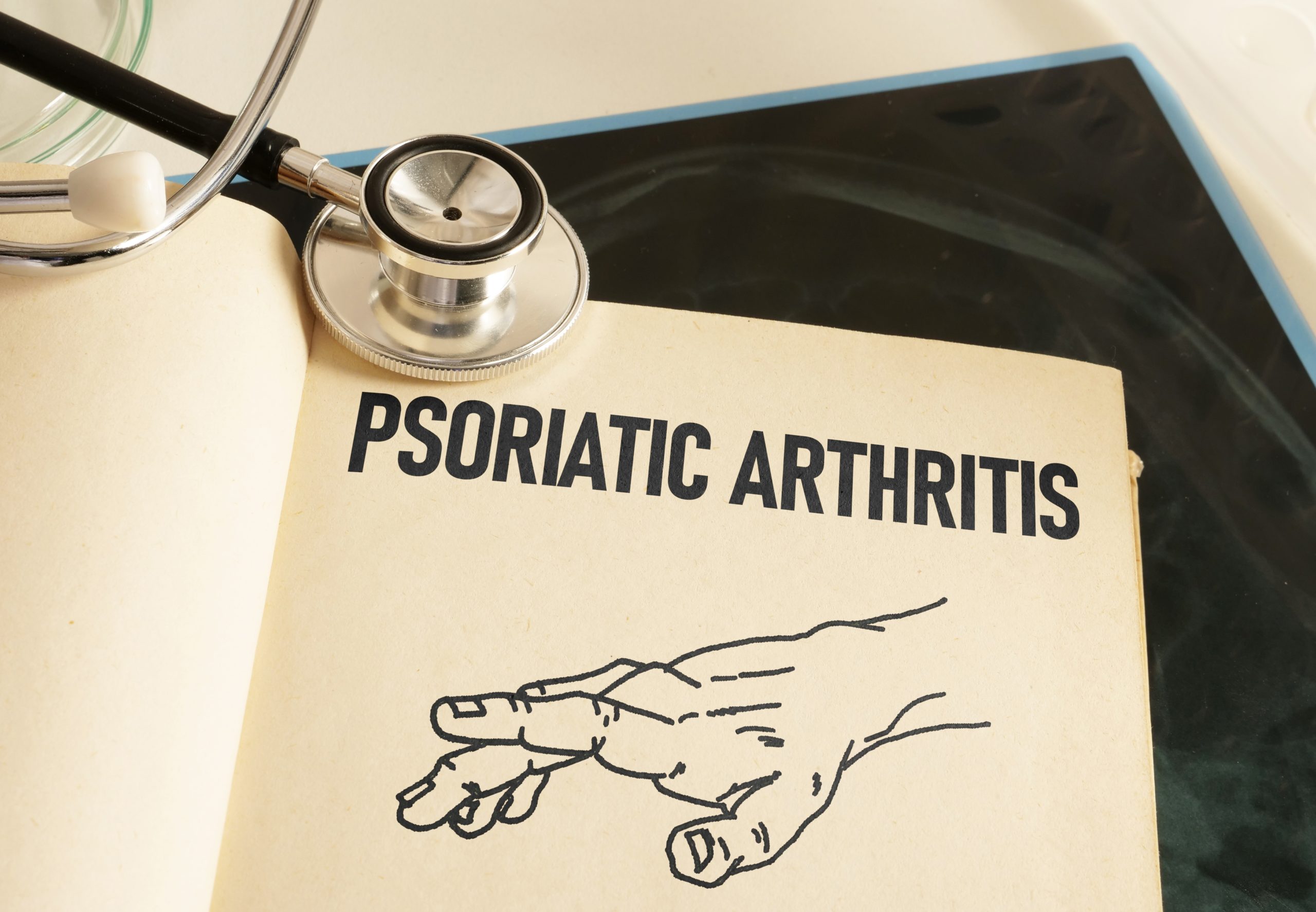 Psoriatic Arthritis is shown using a text